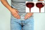 Bladder Cancer reasons, Bladder Cancer experts, why is bladder cancer common in men, Bladder cancer