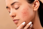 acne, skin, 10 ways to get rid of pimples at home, Skin care